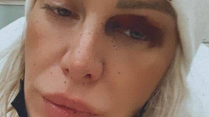 reality-star-bruised-addiction-2840